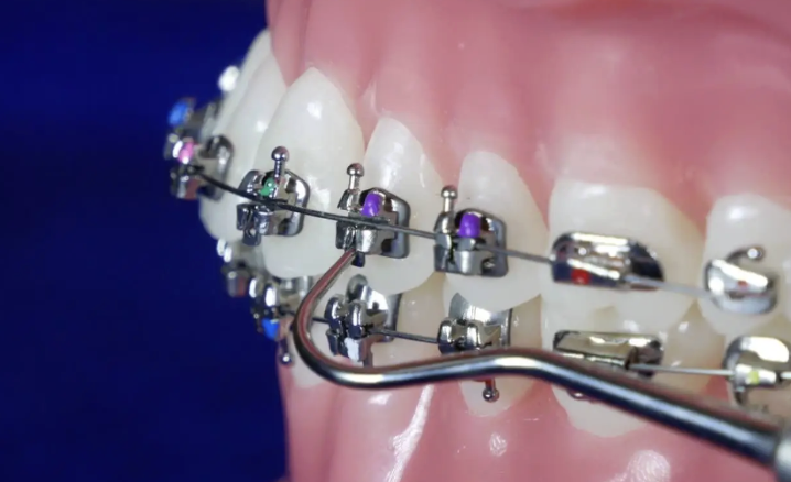 Brackets autoligables en tratamiento de ortodoncia