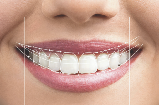 Diseño de sonrisa personalizado